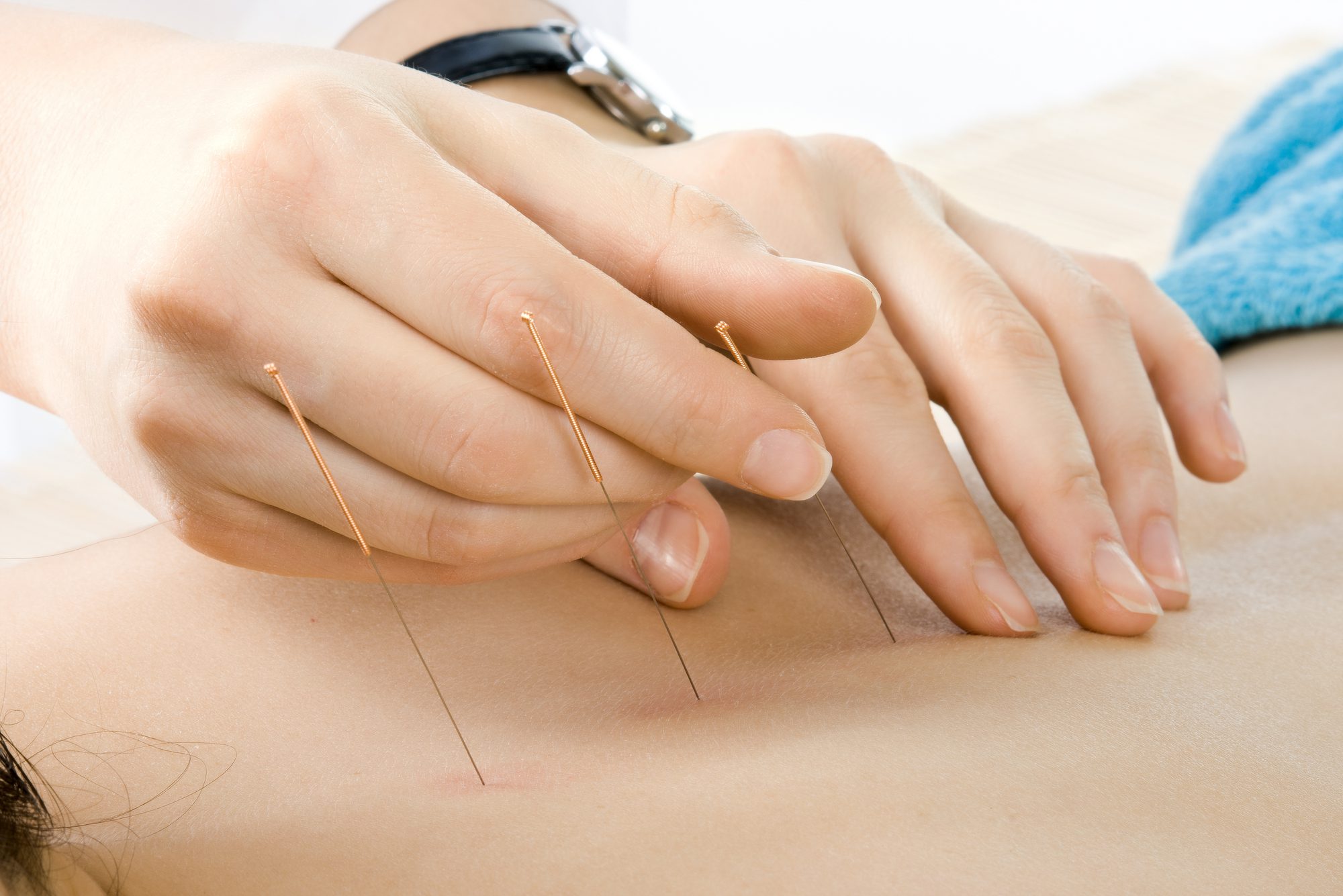 Acupuncture Treatment On The Back Of The Patient